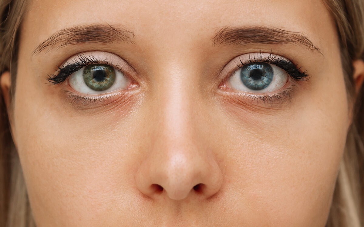 heterocromía qué es