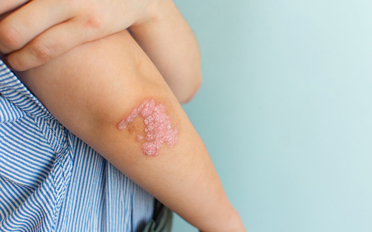 ¿La psoriasis es hereditaria?