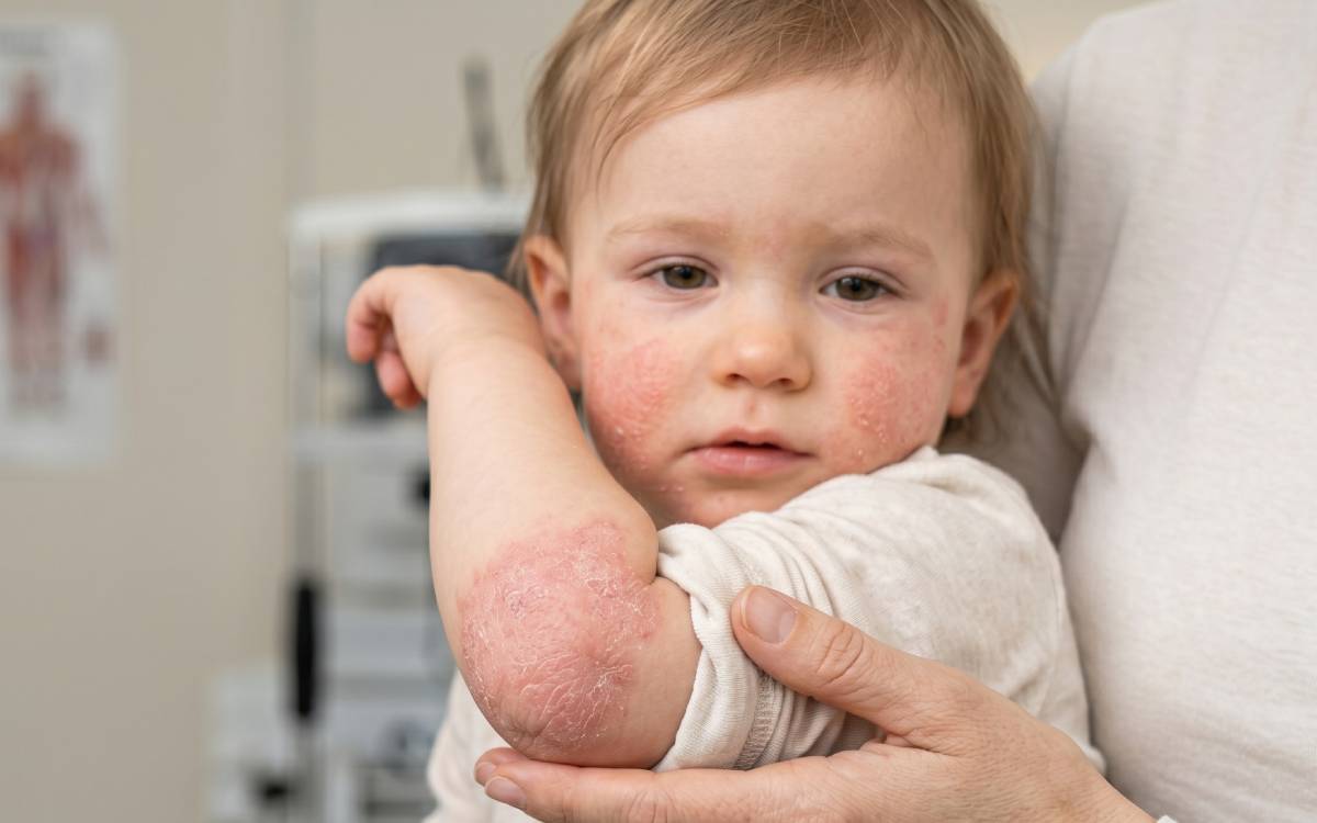 dermatitis atópica en niños