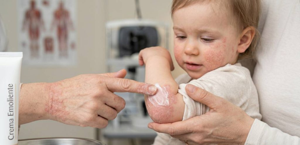 dermatitis atópica en niños
