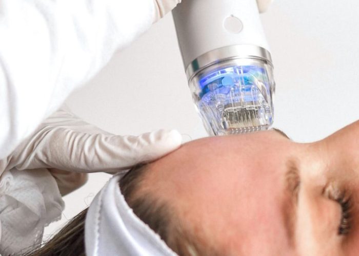 técnicas aplicadas radiofrecuencia fraccionada con agujas