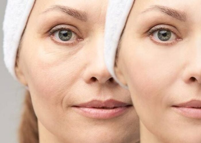 técnicas aplicadas Laser Fraxel 1550