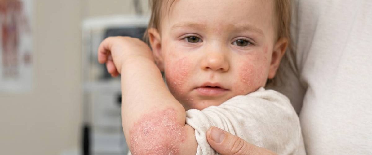 dermatitis atópica en niños