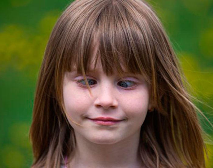 estrabismo tratamiento