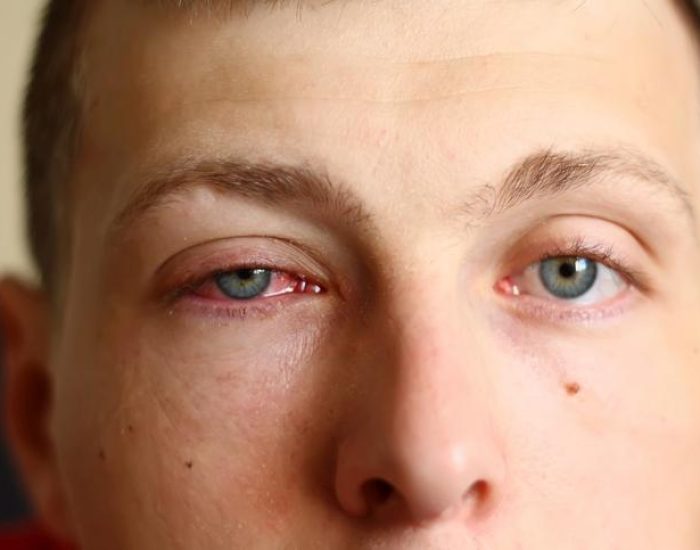A close-up image of a young male face with a pink eye (conjunctivitis). See more in my portfolio