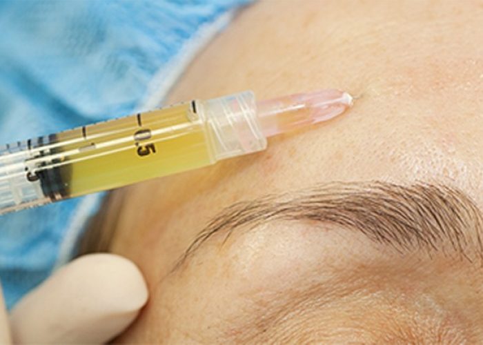 técnicas aplicadas plasma rico en plaquetas