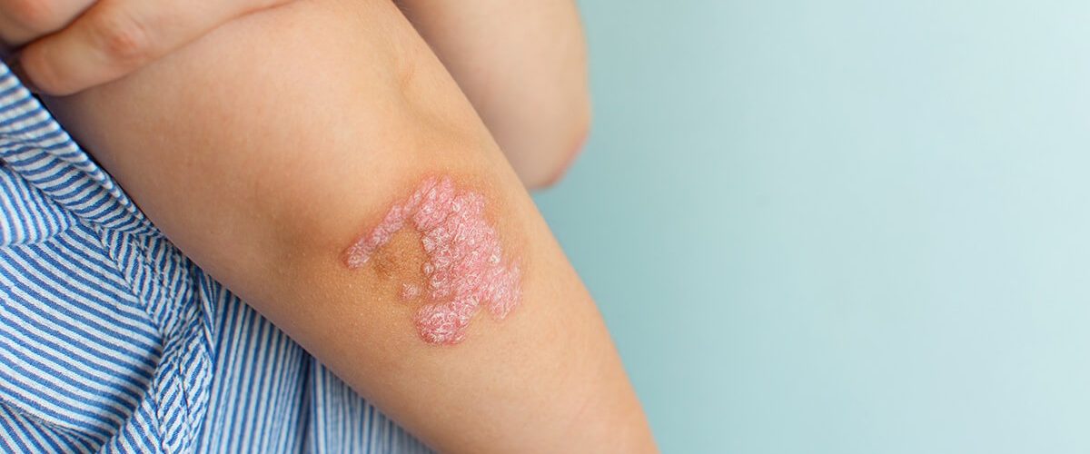¿La psoriasis es hereditaria?