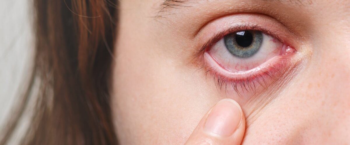 rosácea ocular